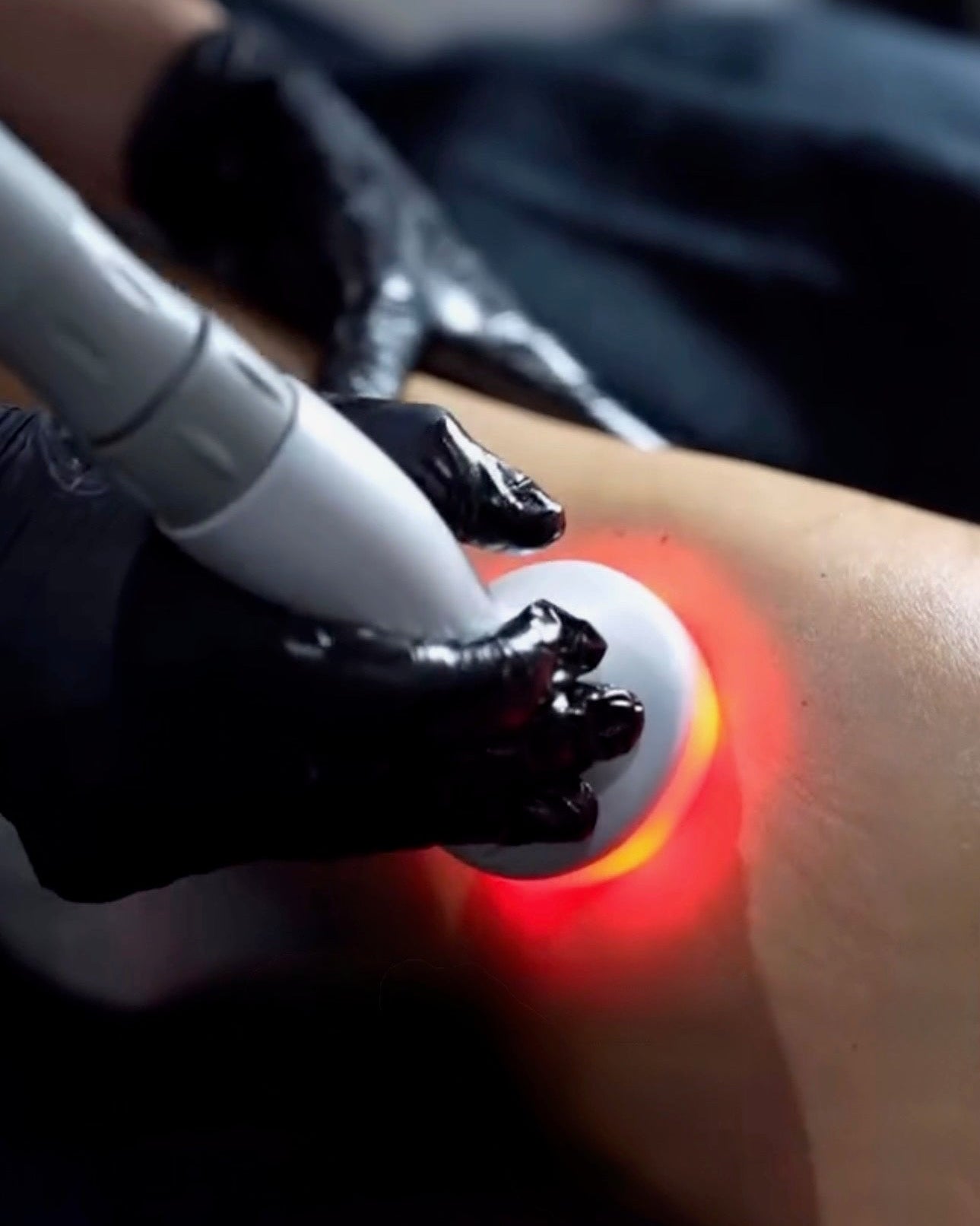 Ultrawave – Cellulite/Fat Reduction & Firming Treatment