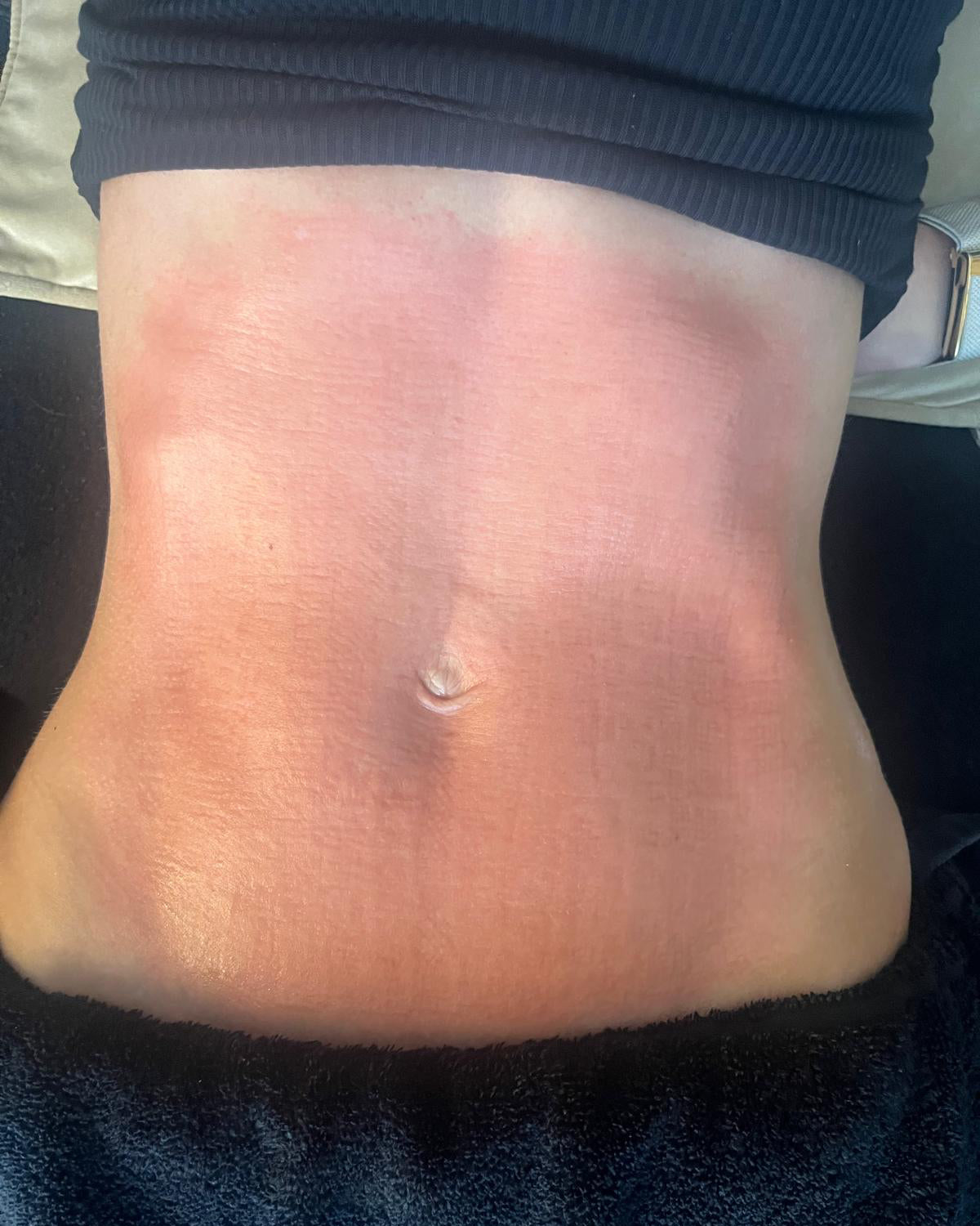 Secrets RF Needling & Body Sculpt Pro - Tummy Skin Tightening & Muscle Toning