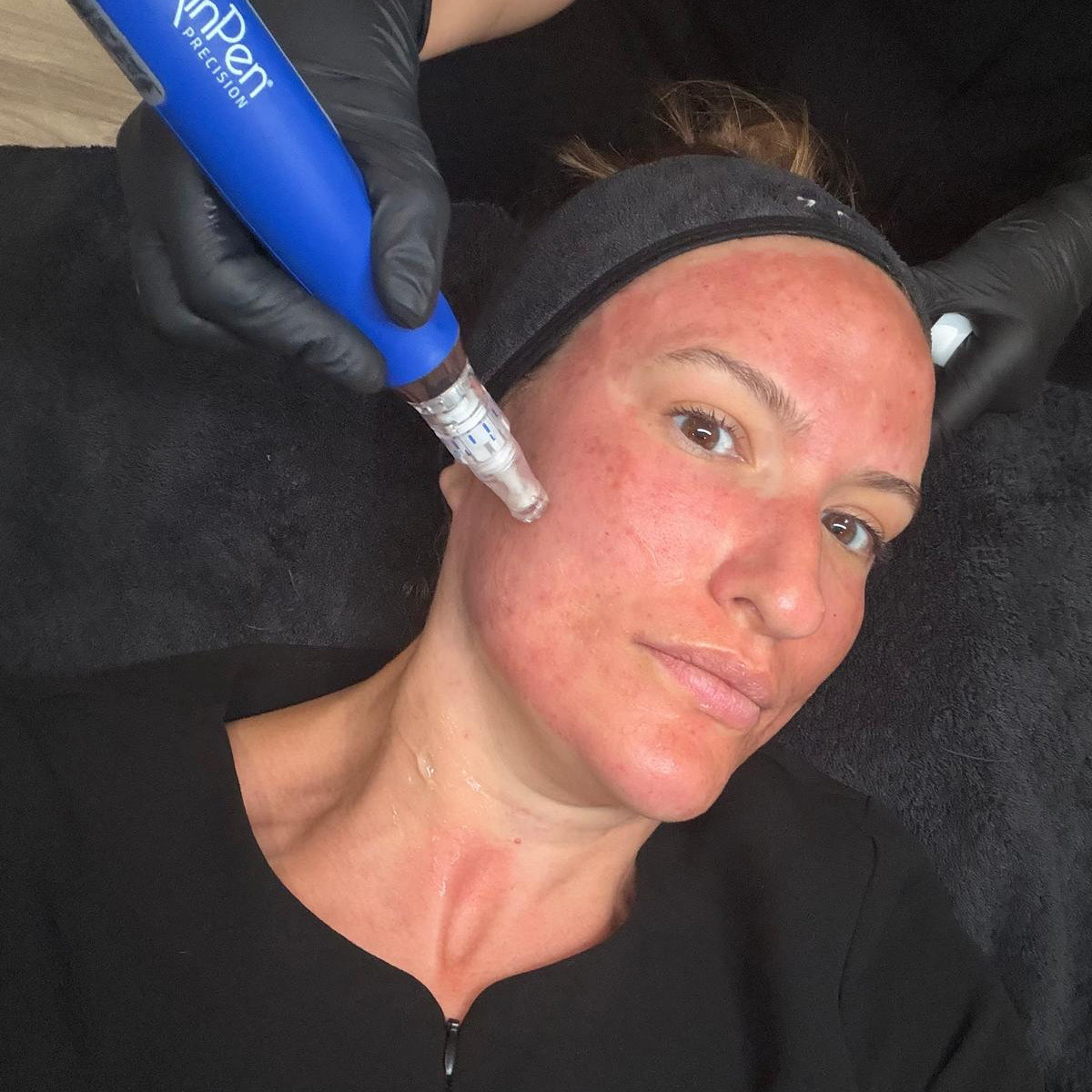 Skin Pen Precision – Face & Neck