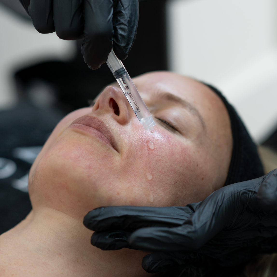 Mesotherapy - Face, Neck & Eyes Skin Tightening & Hydration Cocktail