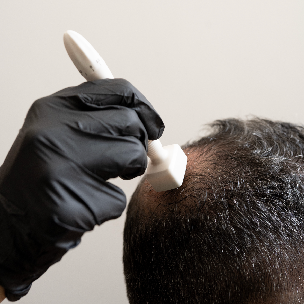 Hair Exosomes with Microneedling & LED