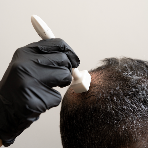 Hair Exosomes with Microneedling & LED