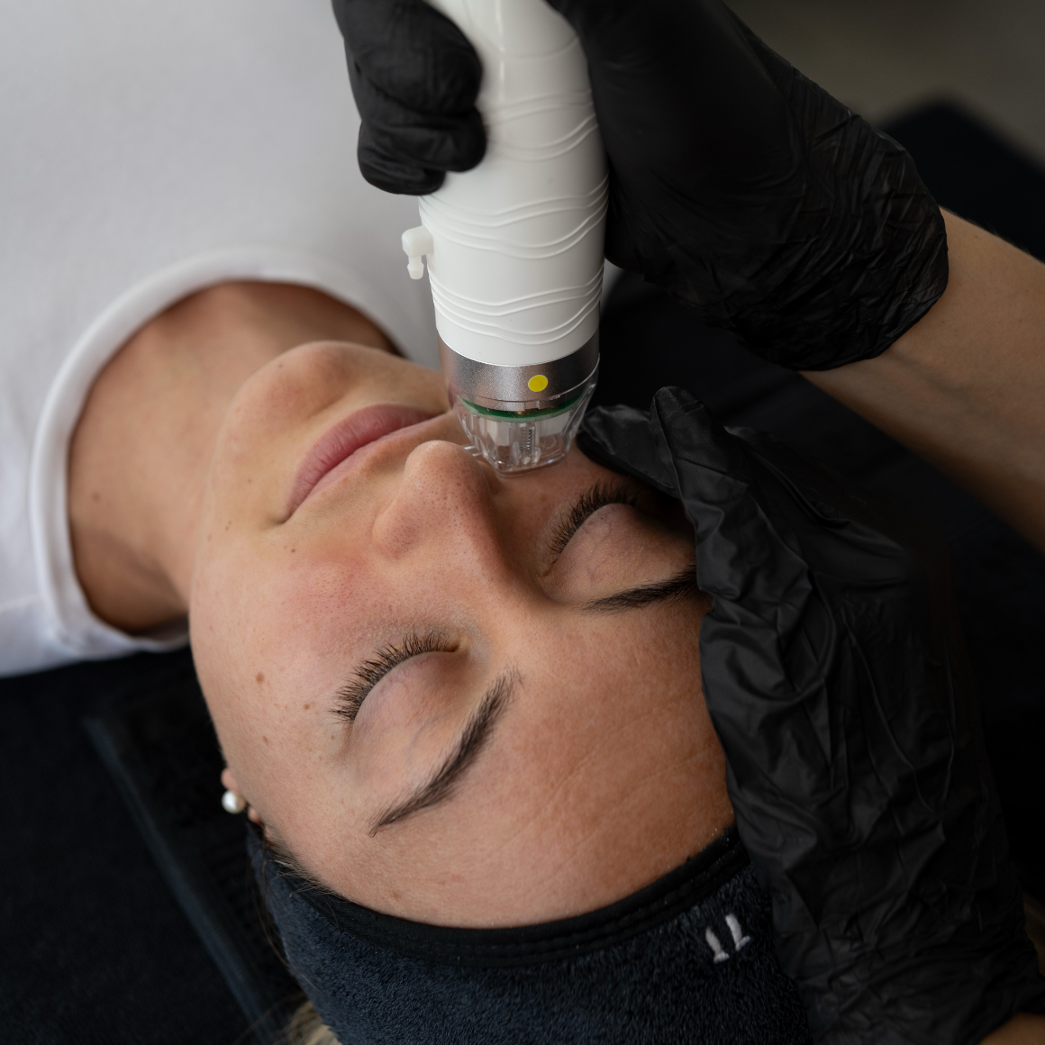 Secrets - RF Needling Facial